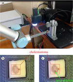 OCT as tool for laser ablation monitoring applied to cholesteatoma
